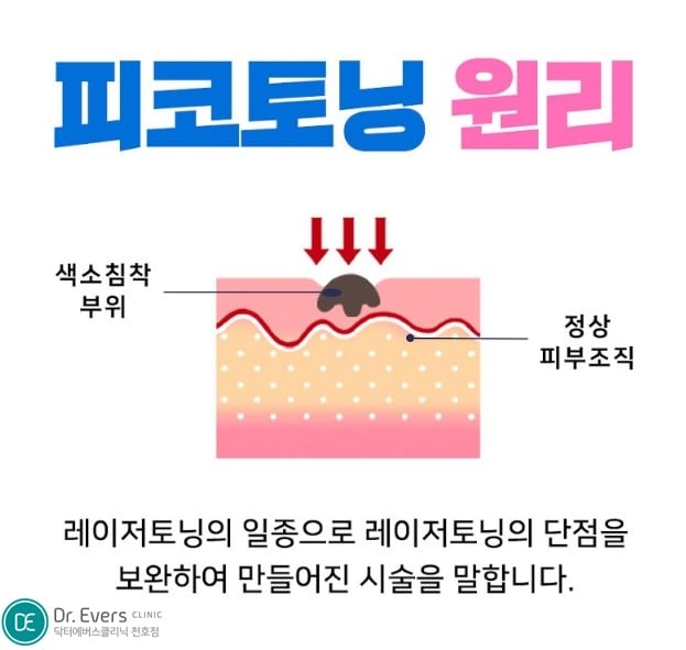 바디 착색토닝 천호피부과 닥터에버스 바디 착색토닝 천호피부과 닥터에버스